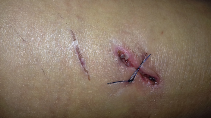 Que faire en cas de non-suture d'une plaie ? 